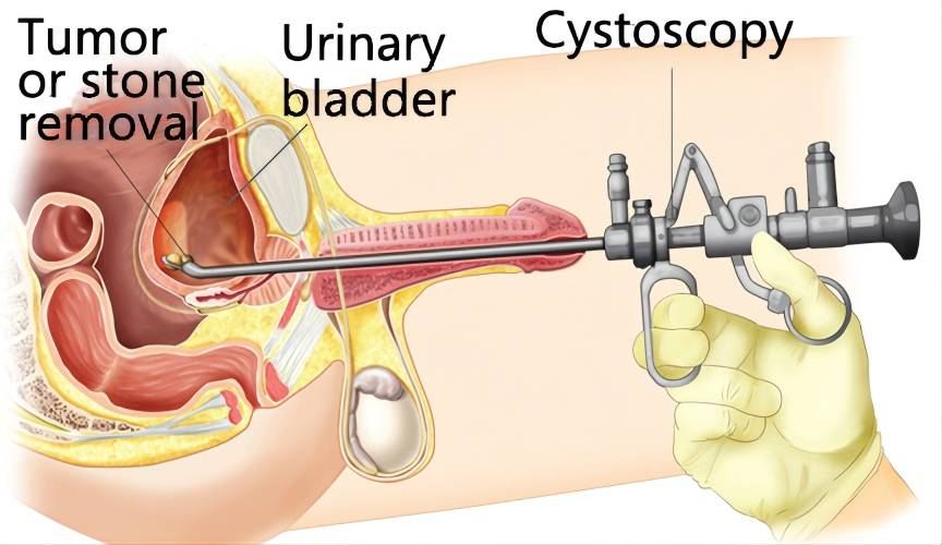 【Cystoscope】What is cystoscopy? What does it do? What is its basic structure?