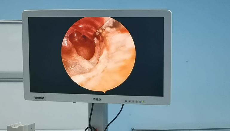 Application of endoscope in ENT operation