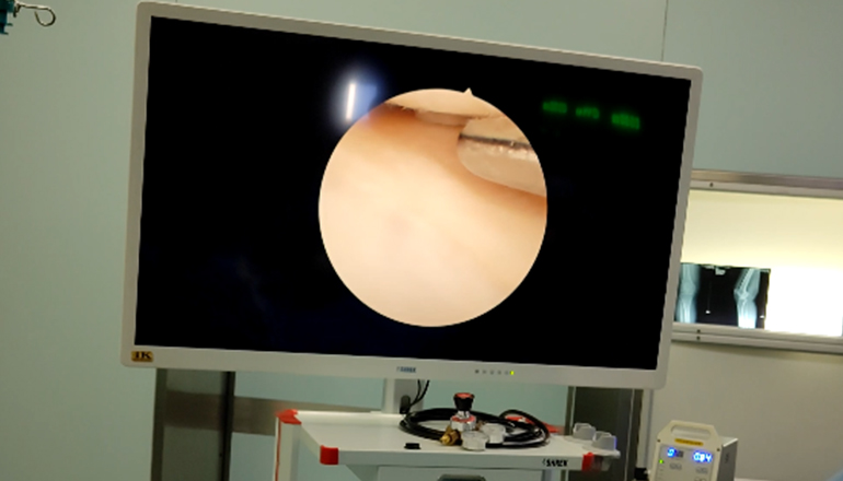 Arthroscopic minimally invasive treatment of 