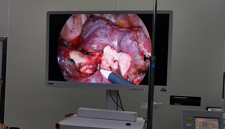 laparoscopic appendectomy