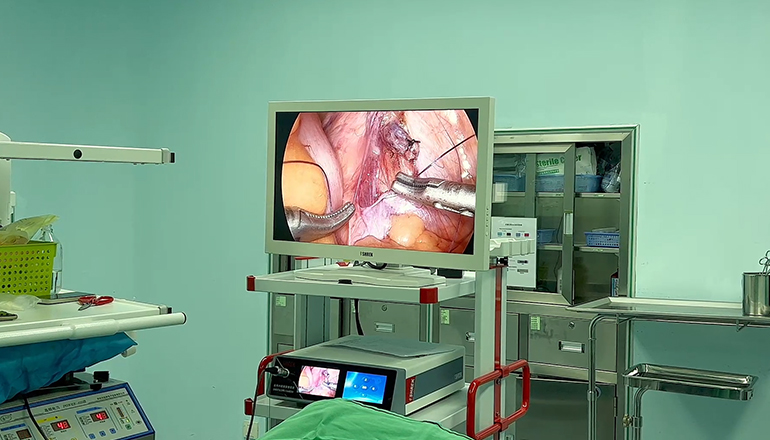 The technique of laparoscopic splenectomy