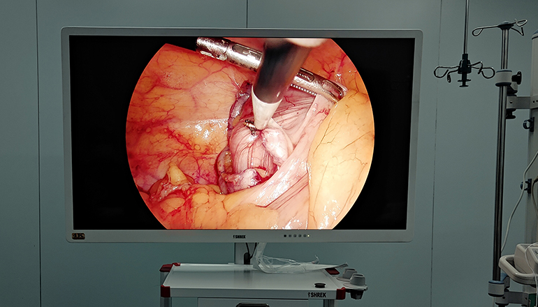 The whole process of laparoscopic appendectomy